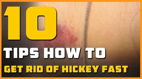 how to get rid of a hickey fast tiktok|More.